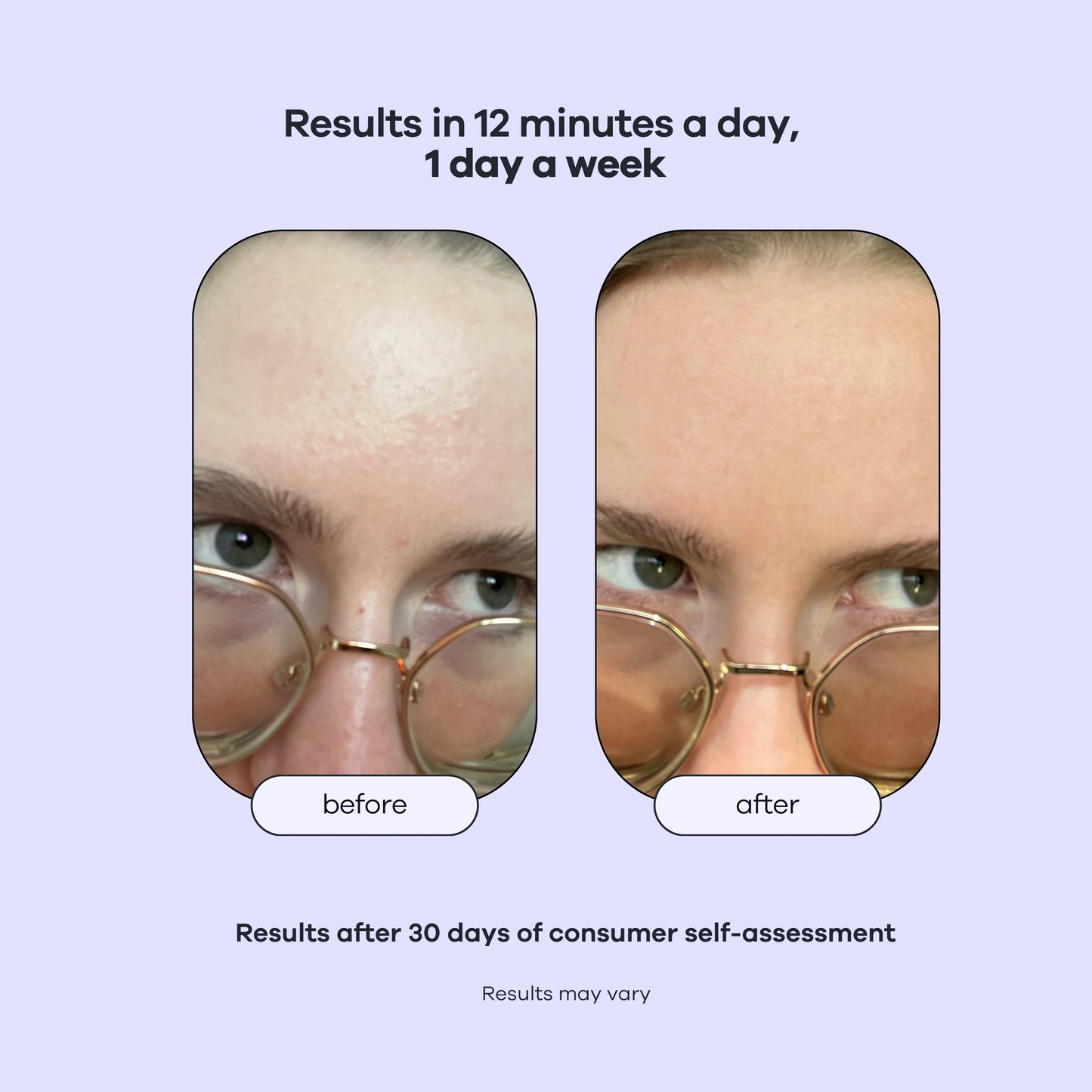 Lumi™ HydraPore Acne Extraction Vacuum