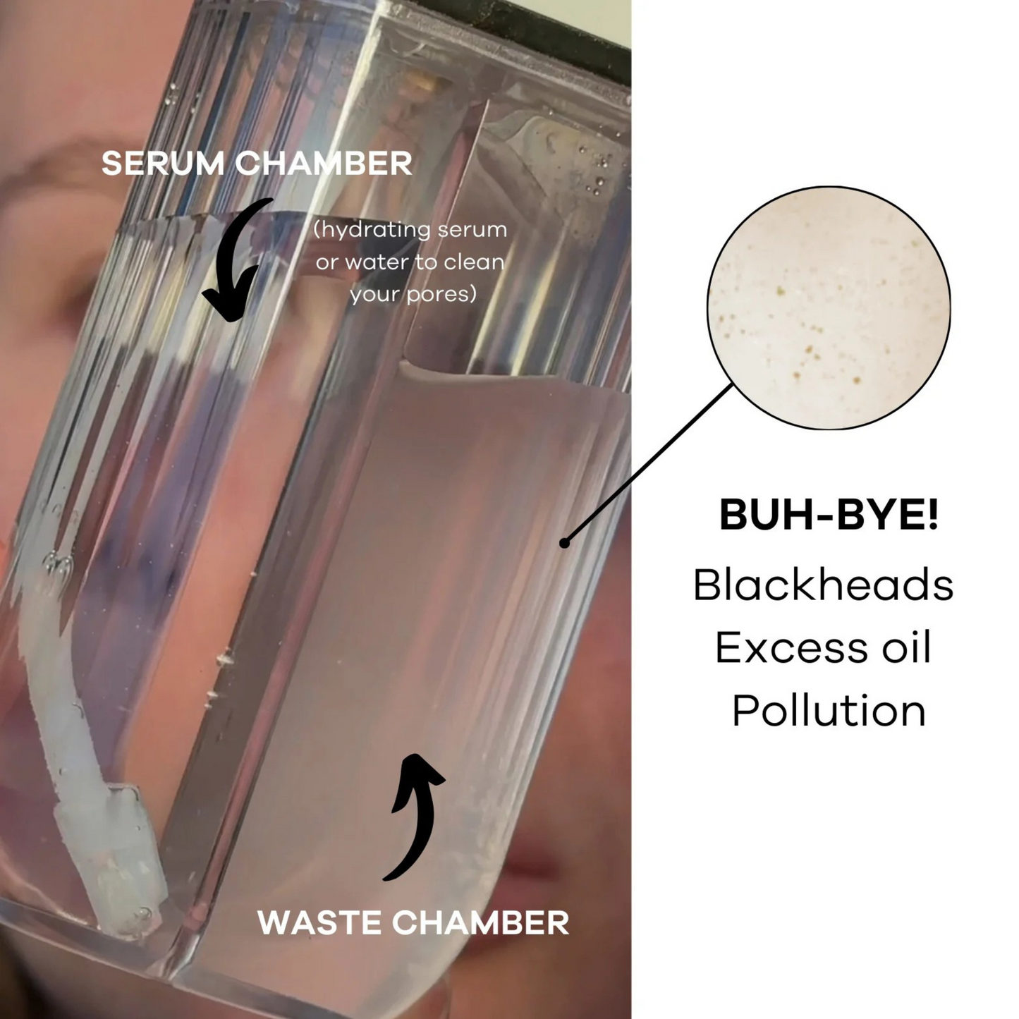 Lumi™ HydraPore Acne Extraction Vacuum
