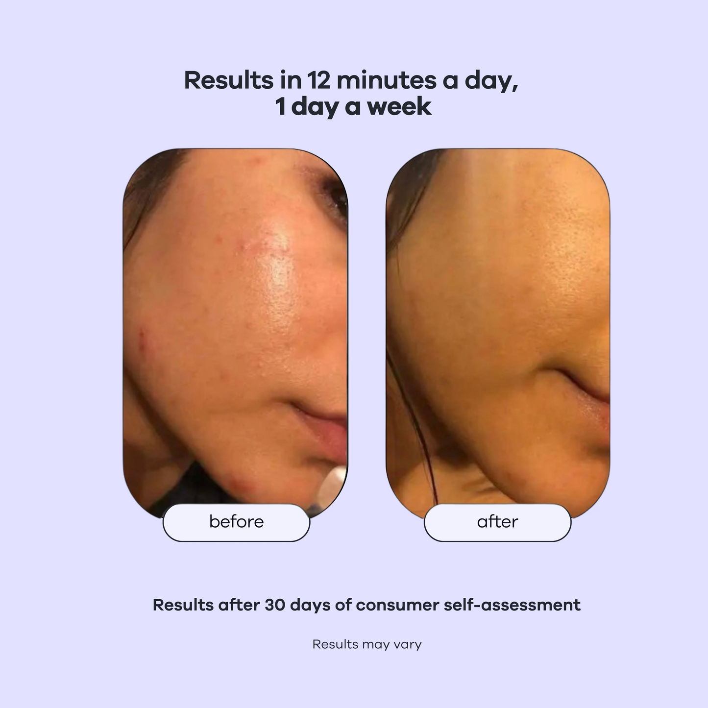 HydraPore™ Deep Cleanse Pore Vacuum