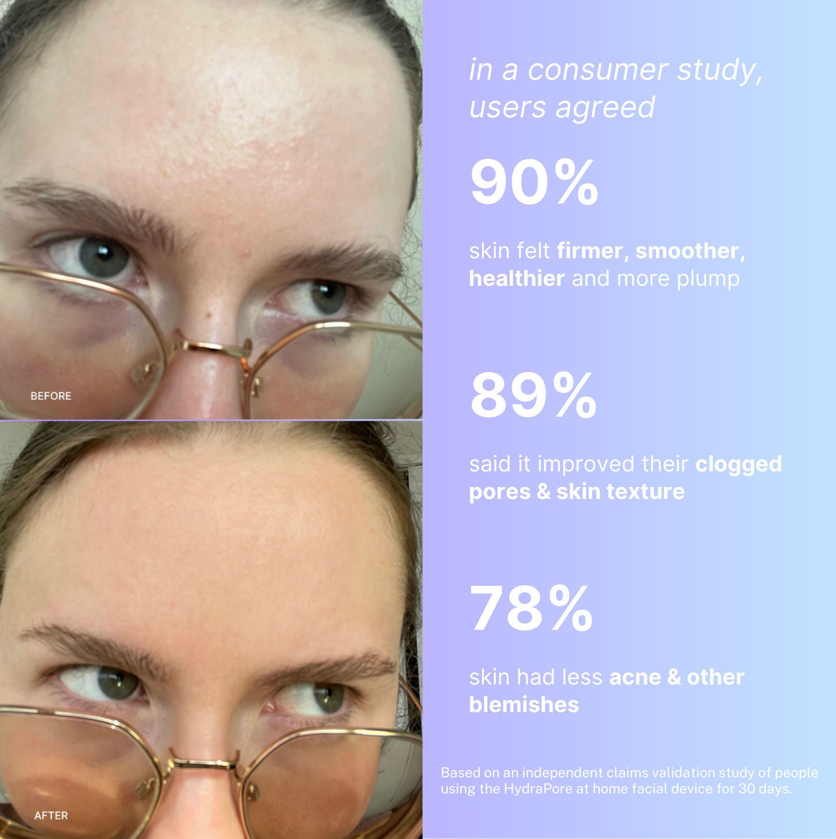 HydraPore™ - All in One Hydrafacial Pore Vacuum