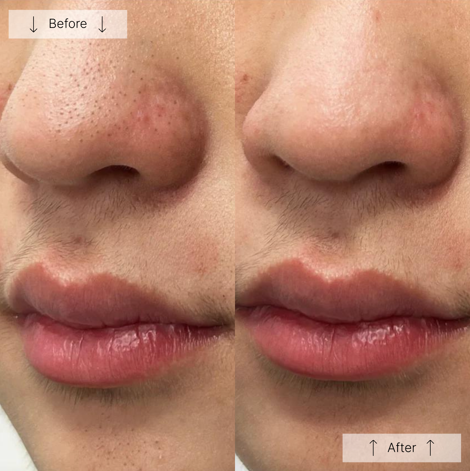HydraPore™ - All in One Hydrafacial Pore Vacuum