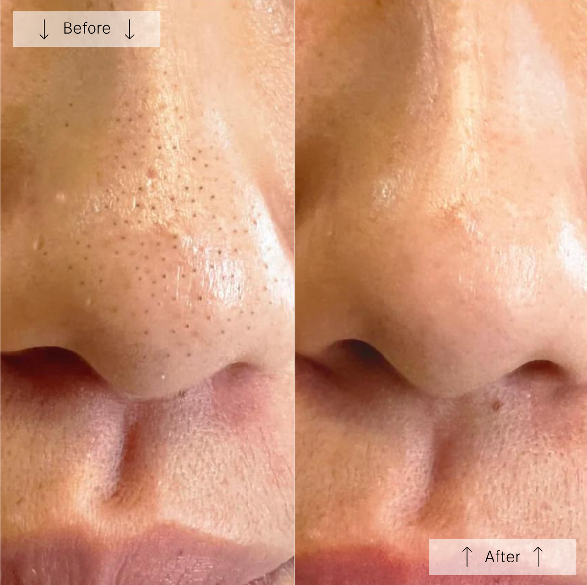 HydraPore™ - All in One Hydrafacial Pore Cleanser
