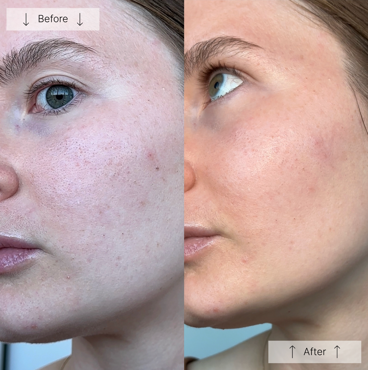 HydraPore™ - All in One Hydrafacial Pore Cleanser